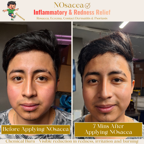NOsacea - Inflammatory &  Redness Relief
