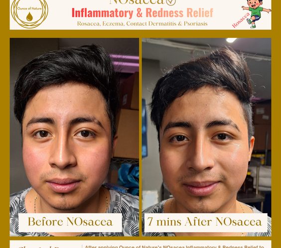 NOsacea - Inflammatory &  Redness Relief