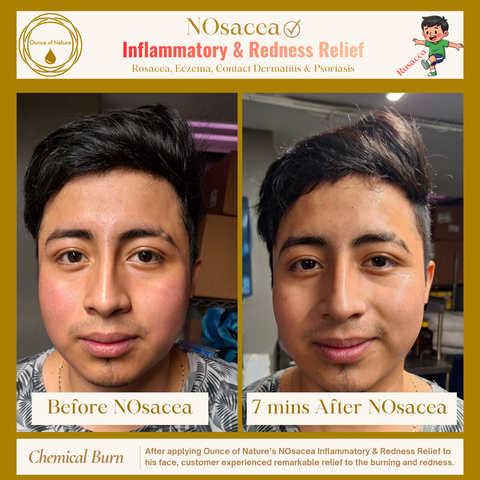 NOsacea - Inflammatory &  Redness Relief